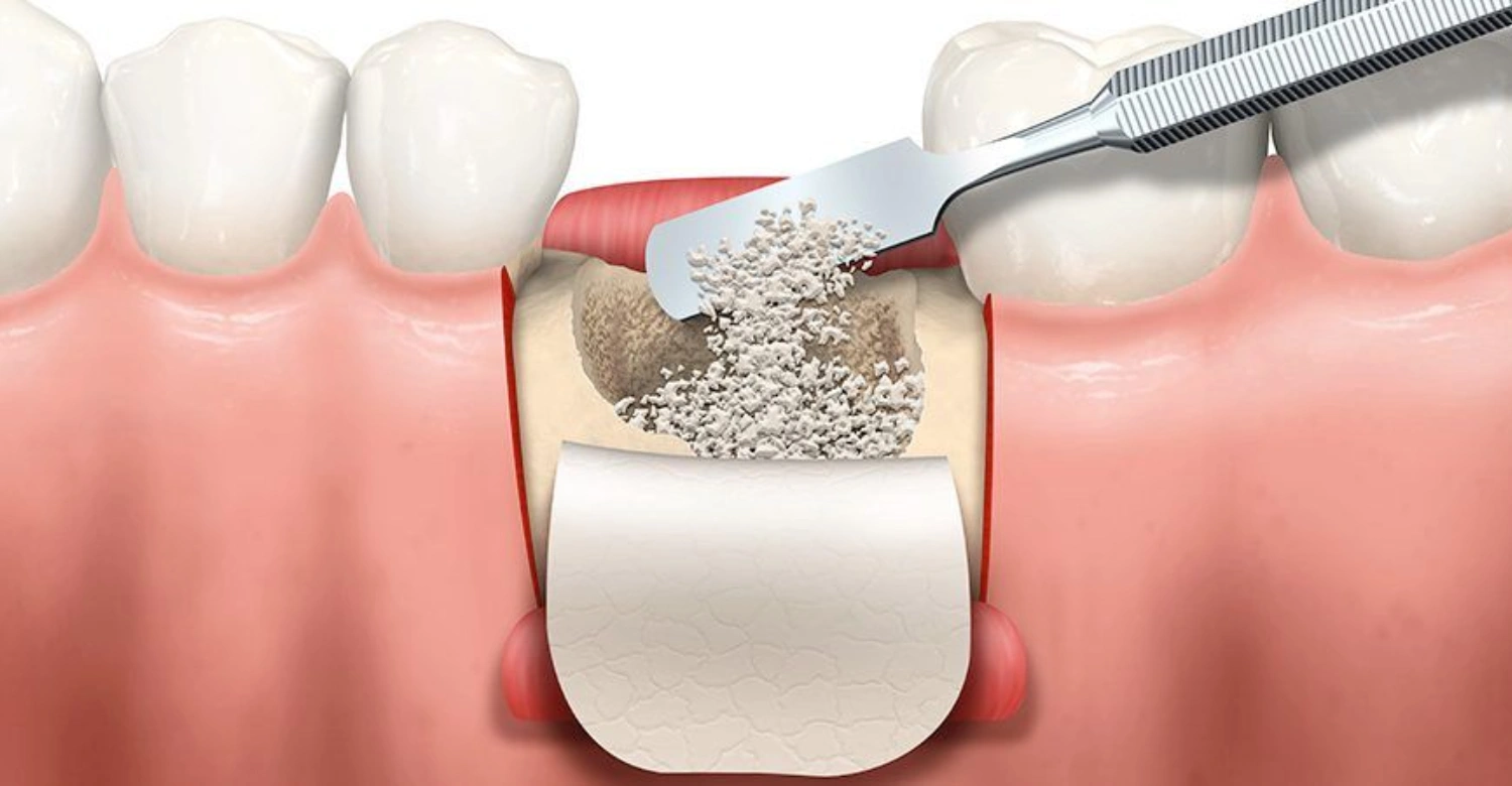 Are bone grafts always necessary for dental implants1